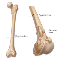 bone cancer