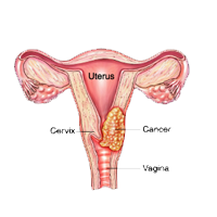 crevical cancer