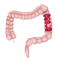 colorectal cancer